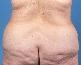 Tummy Tuck Before and After | Dr. Thomas Hubbard