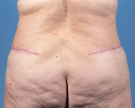 Tummy Tuck Before and After | Dr. Thomas Hubbard