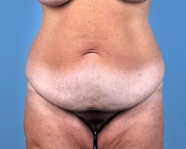 Tummy Tuck Before and After | Dr. Thomas Hubbard