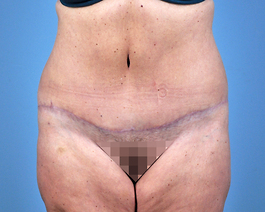 Tummy Tuck Before and After | Dr. Thomas Hubbard