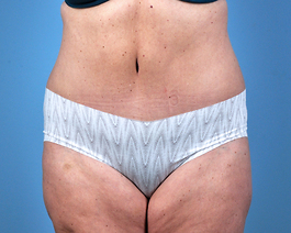 Tummy Tuck Before and After | Dr. Thomas Hubbard