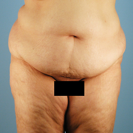 Tummy Tuck Before and After | Dr. Thomas Hubbard