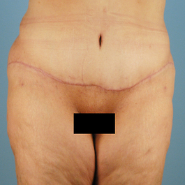 Tummy Tuck Before and After | Dr. Thomas Hubbard