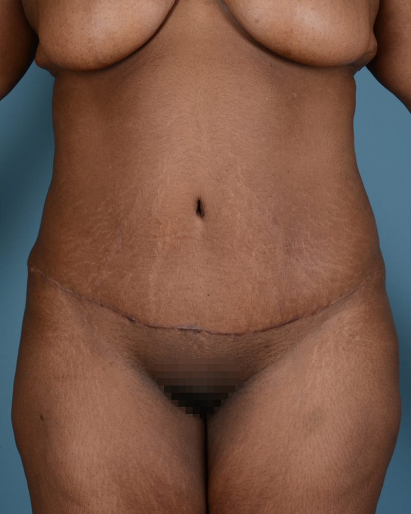 Tummy Tuck Before and After | Dr. Thomas Hubbard