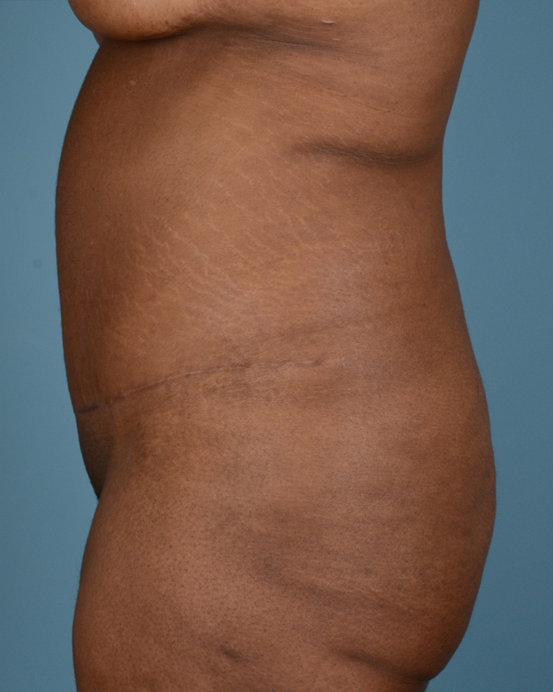 Tummy Tuck Before and After | Dr. Thomas Hubbard