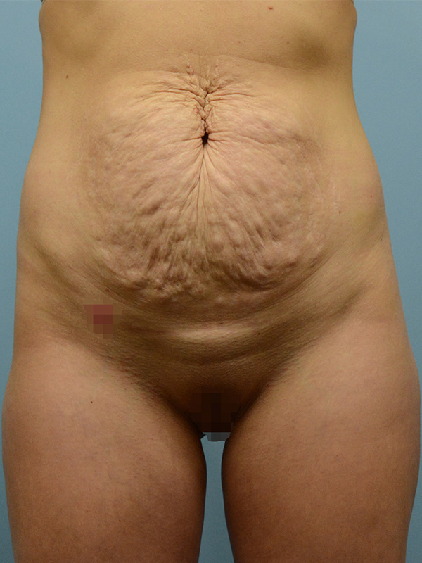 Tummy Tuck Before and After | Dr. Thomas Hubbard
