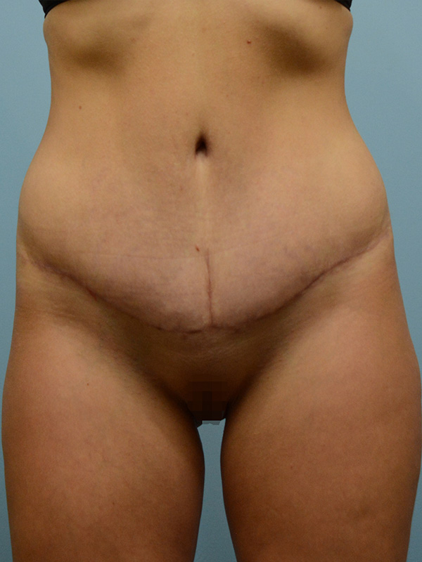 Tummy Tuck Before and After | Dr. Thomas Hubbard