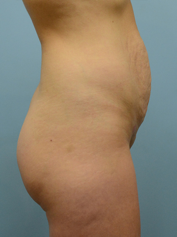 Tummy Tuck Before and After | Dr. Thomas Hubbard