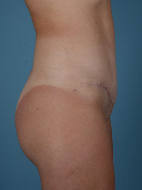 Tummy Tuck Before and After | Dr. Thomas Hubbard