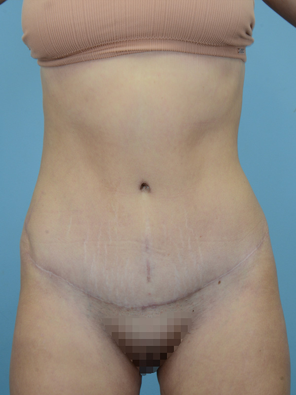 Tummy Tuck Before and After | Dr. Thomas Hubbard