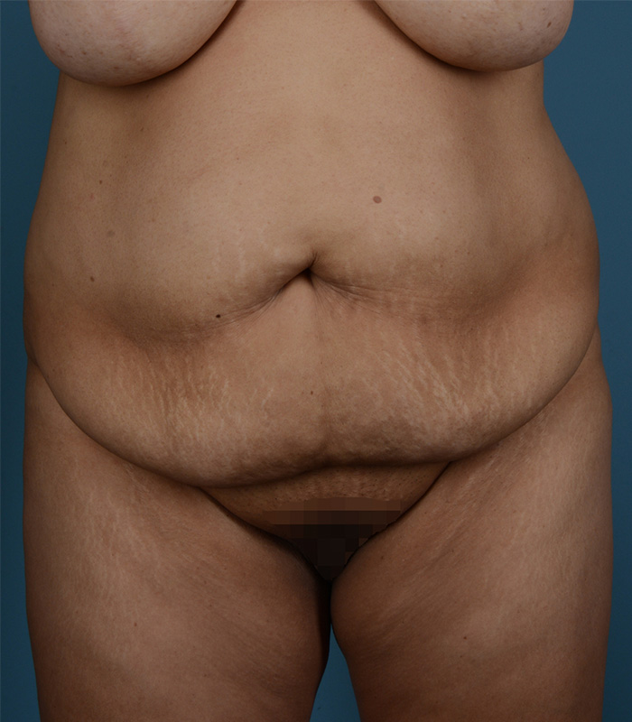 Tummy Tuck Before and After | Dr. Thomas Hubbard