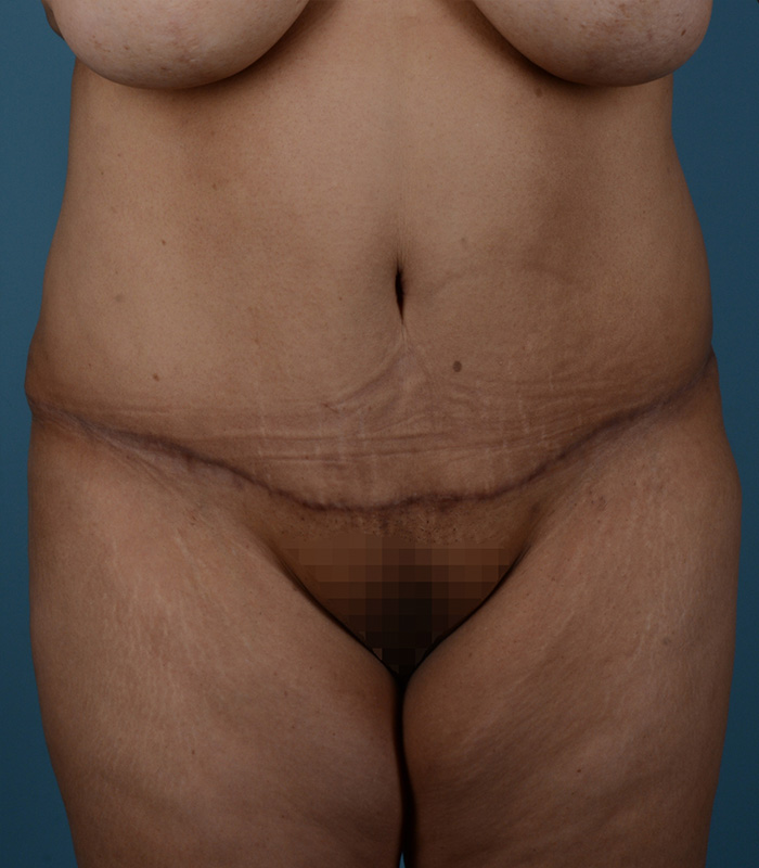 Tummy Tuck Before and After | Dr. Thomas Hubbard