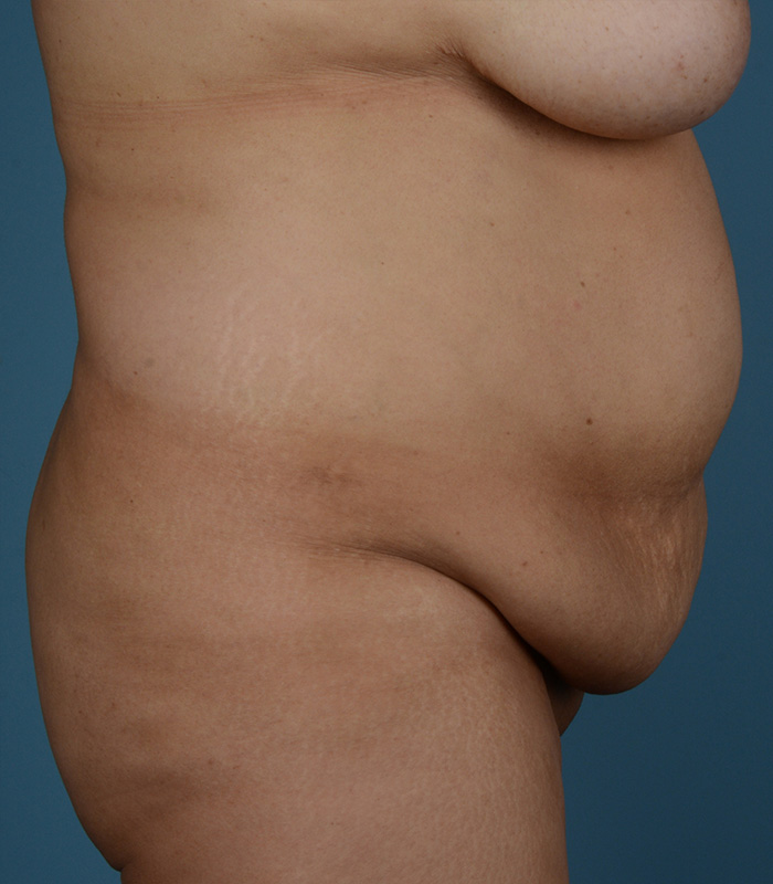 Tummy Tuck Before and After | Dr. Thomas Hubbard