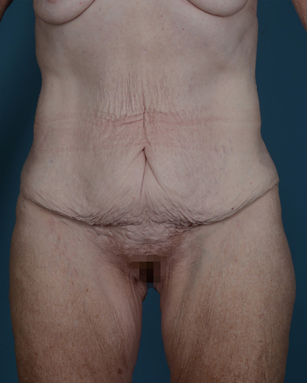Tummy Tuck Before and After | Dr. Thomas Hubbard
