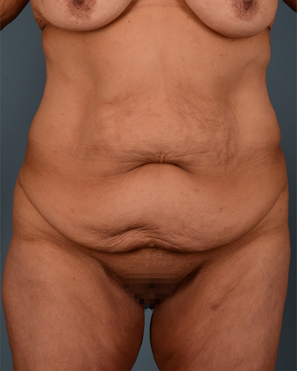Tummy Tuck Before and After | Dr. Thomas Hubbard