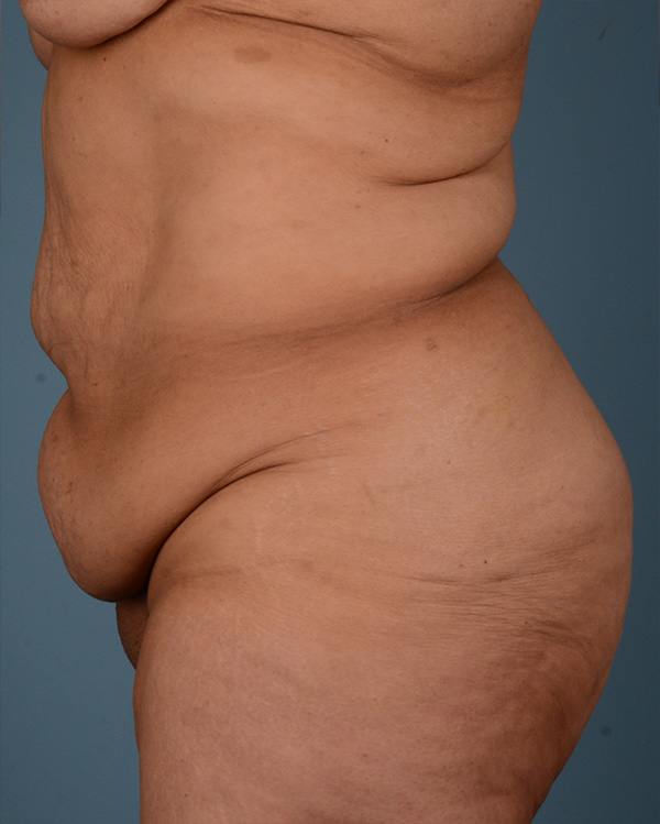Tummy Tuck Before and After | Dr. Thomas Hubbard