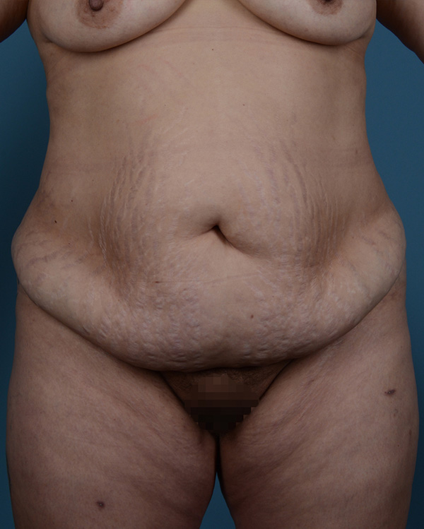 Tummy Tuck Before and After | Dr. Thomas Hubbard