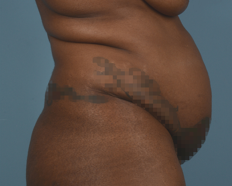 Tummy Tuck Before and After | Dr. Thomas Hubbard
