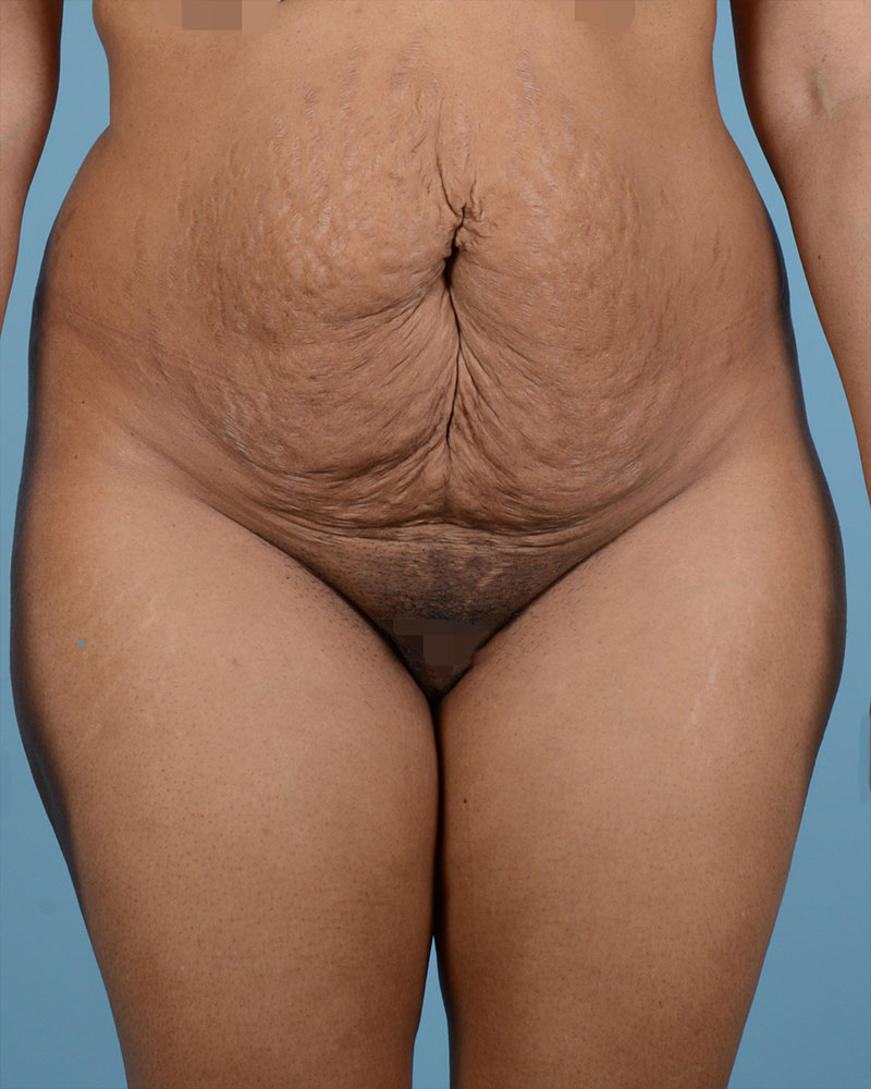 Tummy Tuck Before and After | Dr. Thomas Hubbard