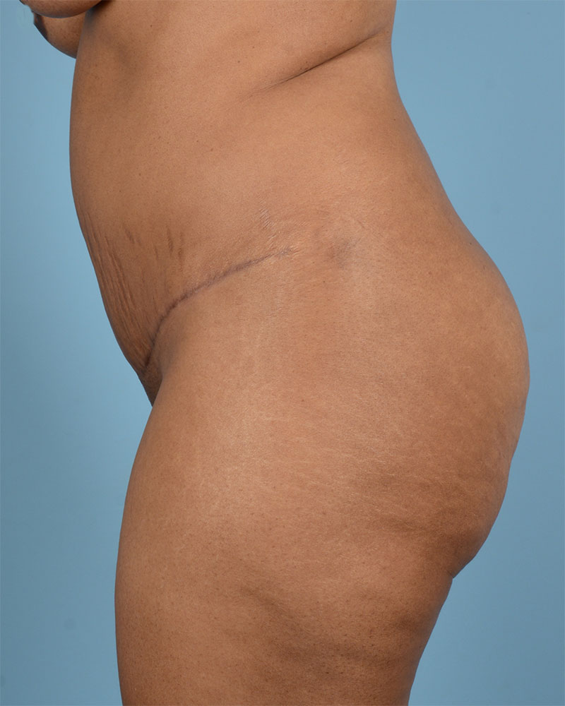 Tummy Tuck Before and After | Dr. Thomas Hubbard