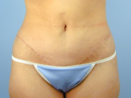 Tummy Tuck Before and After | Dr. Thomas Hubbard