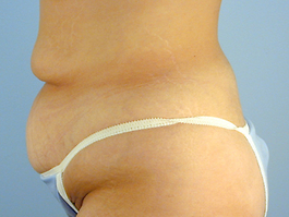 Tummy Tuck Before and After | Dr. Thomas Hubbard