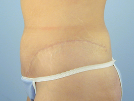 Tummy Tuck Before and After | Dr. Thomas Hubbard