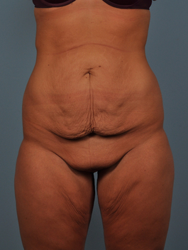 Tummy Tuck Before and After | Dr. Thomas Hubbard