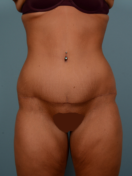 Tummy Tuck Before and After | Dr. Thomas Hubbard