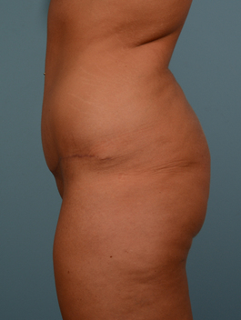 Tummy Tuck Before and After | Dr. Thomas Hubbard