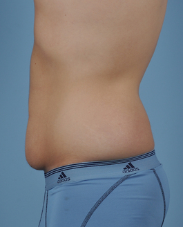 Tummy Tuck Before and After | Dr. Thomas Hubbard