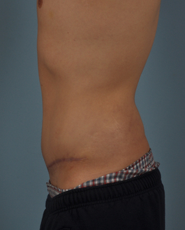 Tummy Tuck Before and After | Dr. Thomas Hubbard