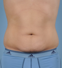 Tummy Tuck Before and After | Dr. Thomas Hubbard