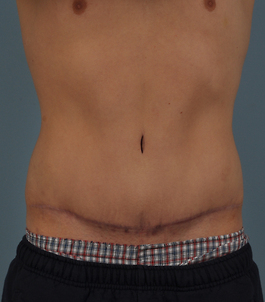 Tummy Tuck Before and After | Dr. Thomas Hubbard