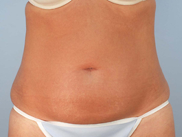 Tummy Tuck Before and After | Dr. Thomas Hubbard