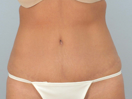 Tummy Tuck Before and After | Dr. Thomas Hubbard