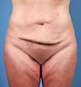 Tummy Tuck Before and After | Dr. Thomas Hubbard