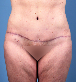 Tummy Tuck Before and After | Dr. Thomas Hubbard