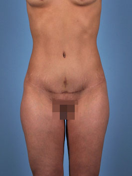 Tummy Tuck Before and After | Dr. Thomas Hubbard