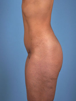 Tummy Tuck Before and After | Dr. Thomas Hubbard