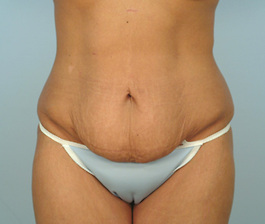 Tummy Tuck Before and After | Dr. Thomas Hubbard