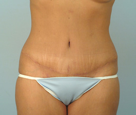 Tummy Tuck Before and After | Dr. Thomas Hubbard