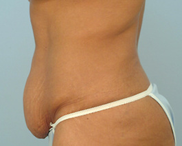 Tummy Tuck Before and After | Dr. Thomas Hubbard