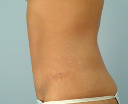 Tummy Tuck Before and After | Dr. Thomas Hubbard