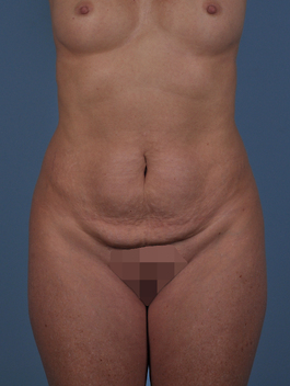 Tummy Tuck Before and After | Dr. Thomas Hubbard