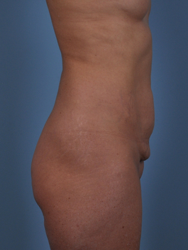 Tummy Tuck Before and After | Dr. Thomas Hubbard