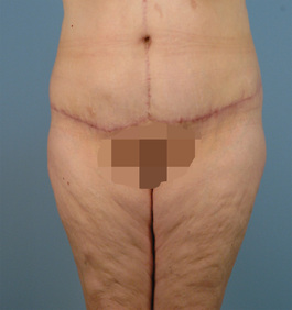 Tummy Tuck Before and After | Dr. Thomas Hubbard