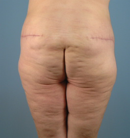 Tummy Tuck Before and After | Dr. Thomas Hubbard