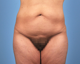 Tummy Tuck Before and After | Dr. Thomas Hubbard