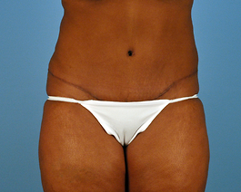 Tummy Tuck Before and After | Dr. Thomas Hubbard